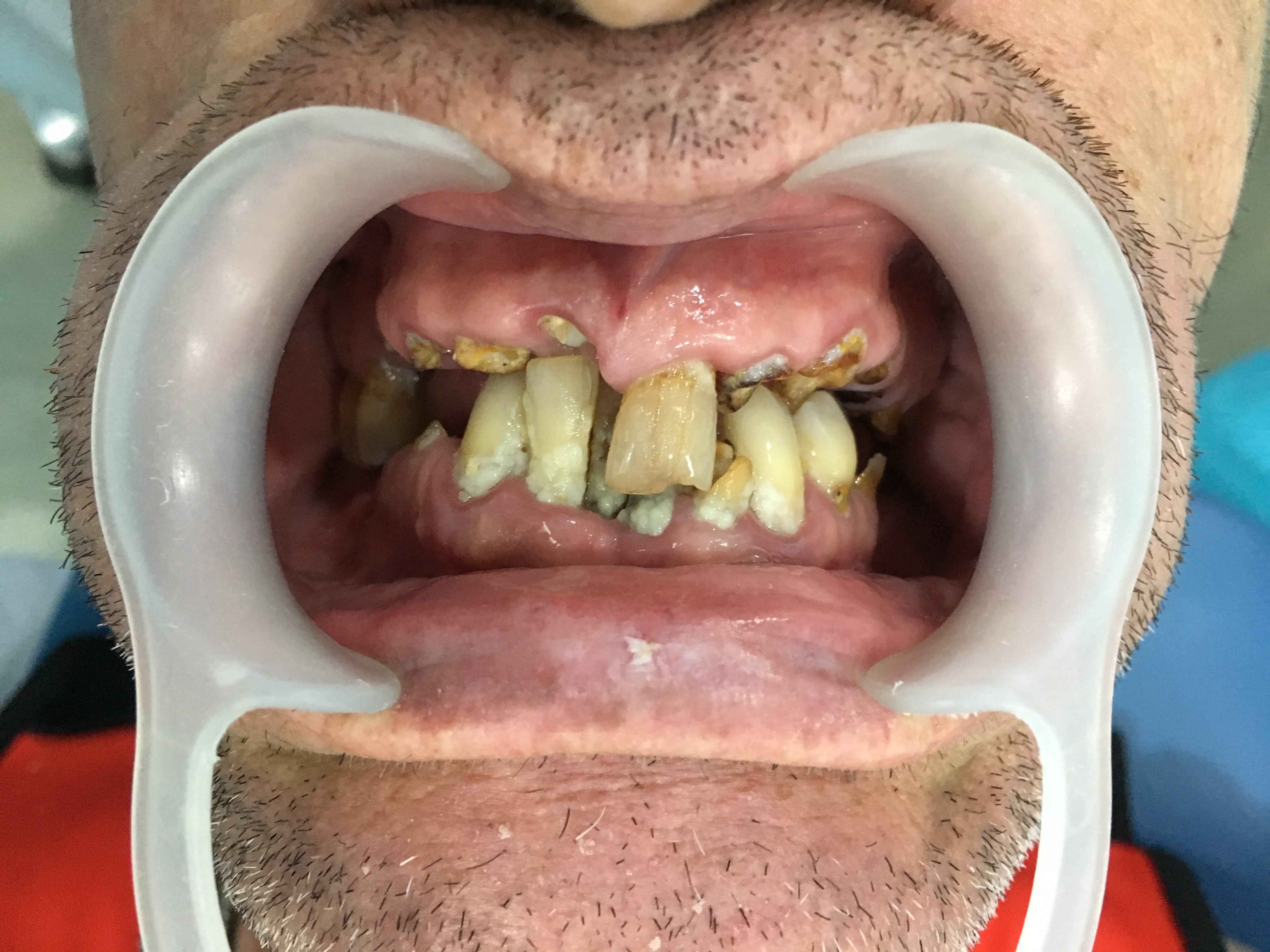 Review Implant Bangkok Dental Dentist Clinic By Bangkok Smile Dental 